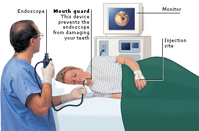 Gastroscopy Procedure